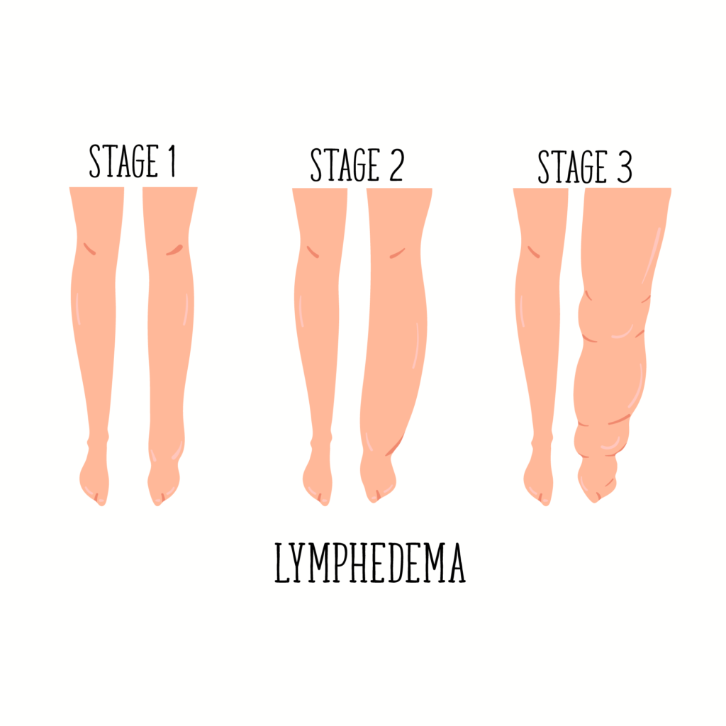 stages of lymphedema 