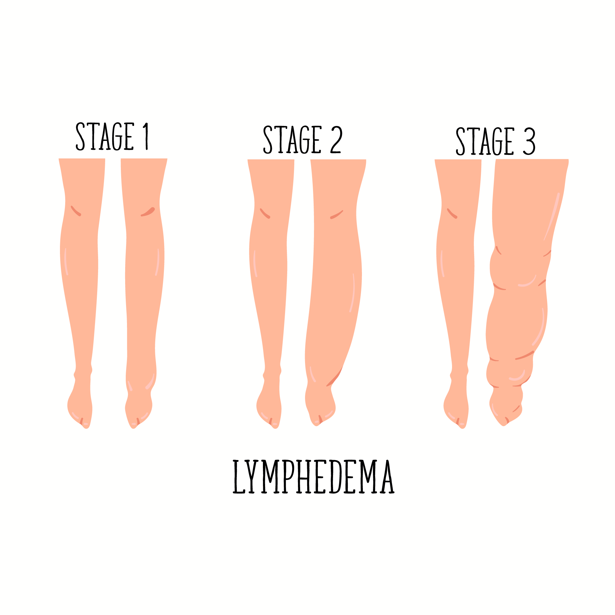 Guide To Lymphedema Treatment - PRN Home Health And Therapy